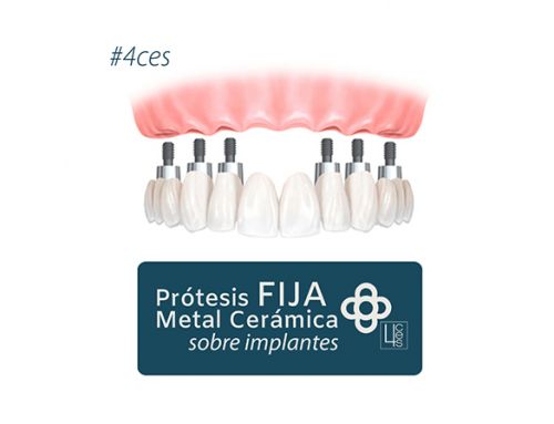 Prótesis Fija de Metal Cerámica sobre Implantes