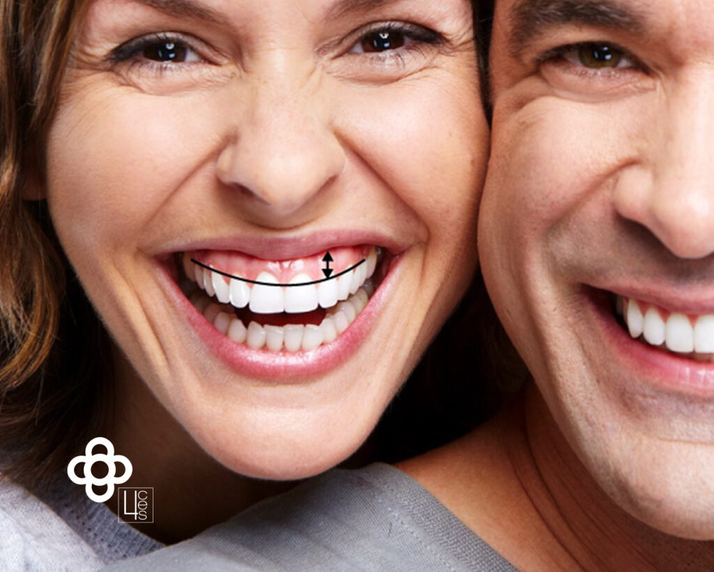 sonrisa gingival