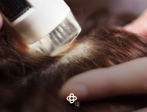 Mesoterapia capilar para frenar la caída de cabello