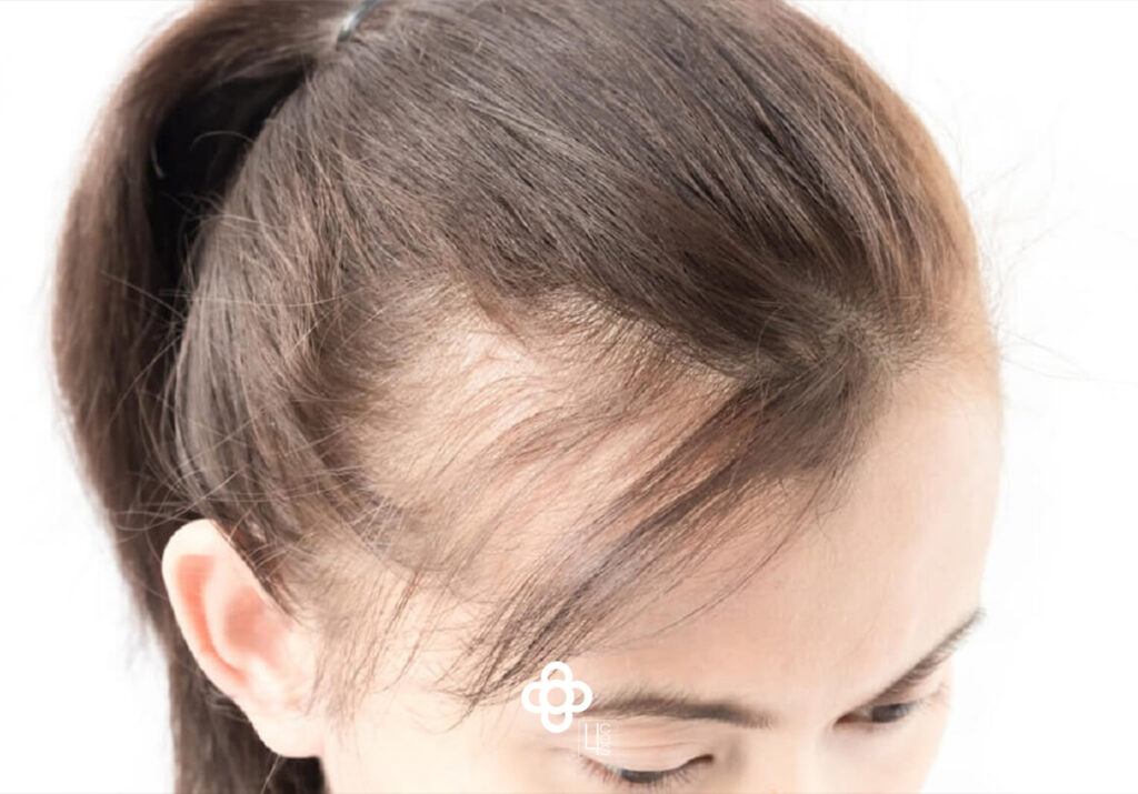 pérdidapelomujeres catroces web