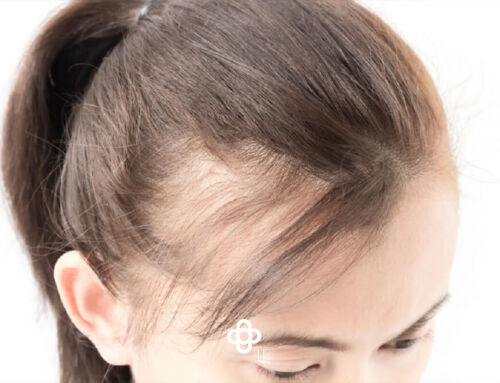 ¿Qué tipos de alopecia o calvicie son habituales en mujeres?