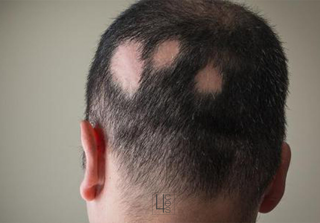 alopeciaareata catroces web