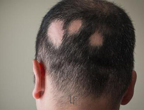 Alopecia Areata: una alopecia que se puede tratar