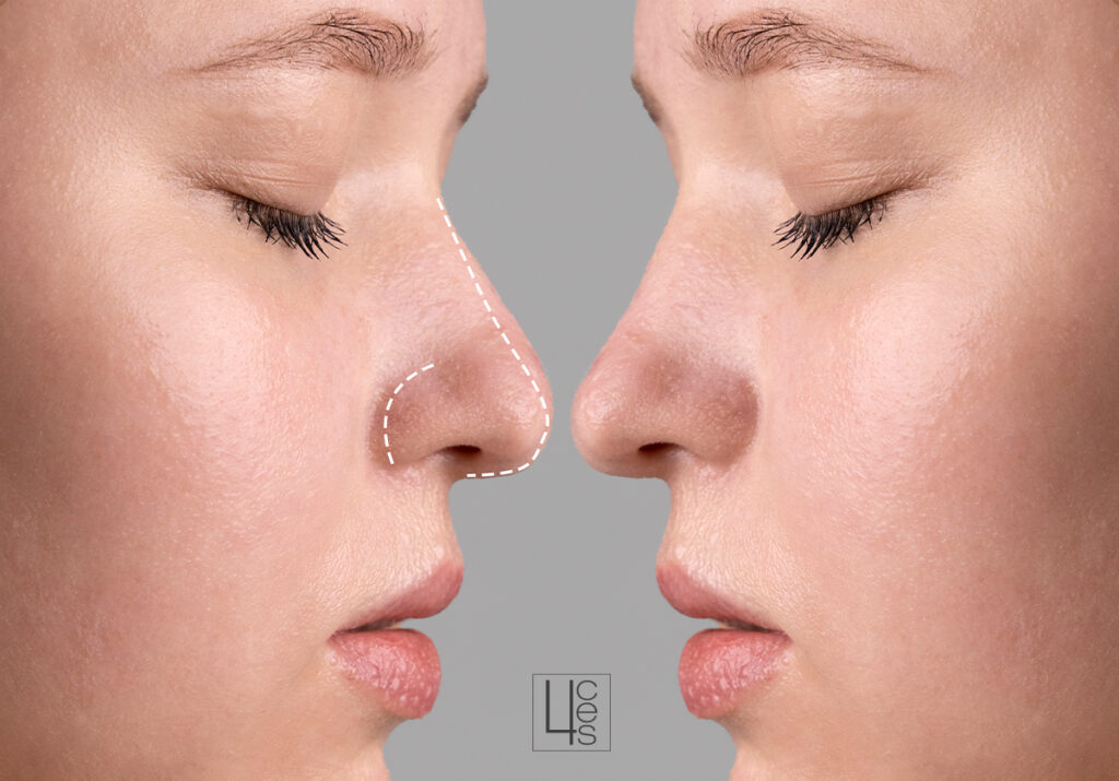 rinomodelación catroces web