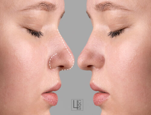 Cómo cambiar el aspecto de tu nariz sin pasar por quirófano
