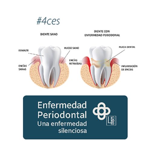 enfermedad periodontal