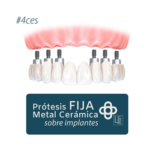 prótesis fija de metal cerámica