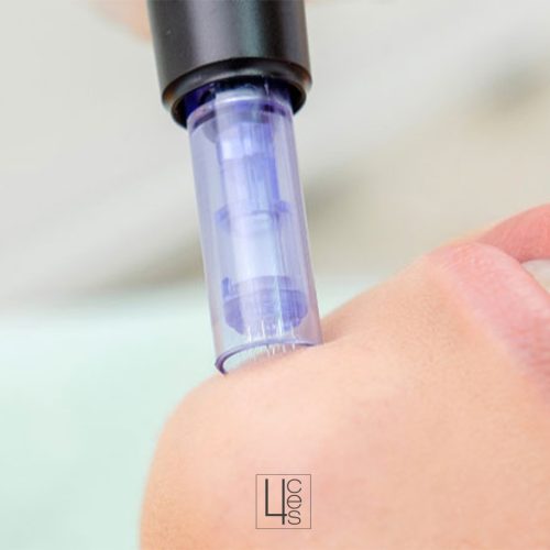 microneedling catroces web