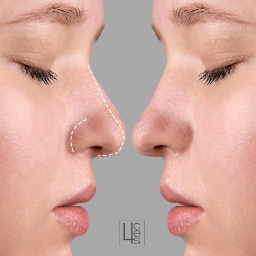 rinomodelación catroces web